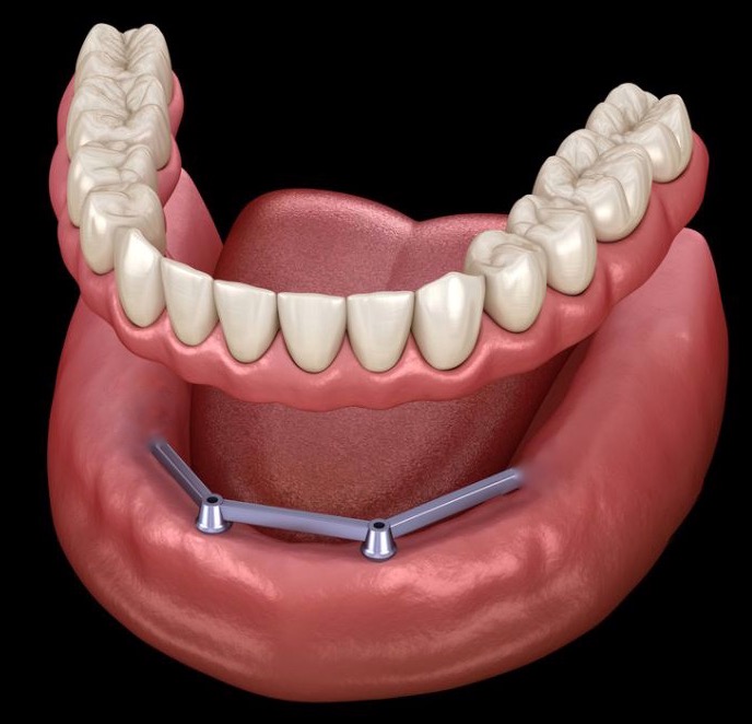 Overdenture Barra Clip 2.jpg