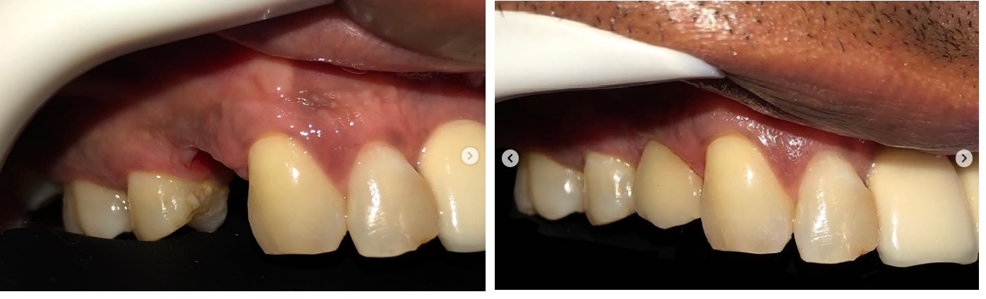 Implante Unitário.jpg